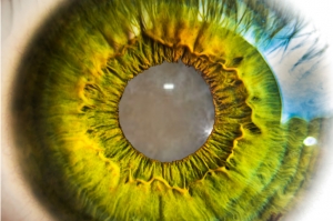 Cataracr