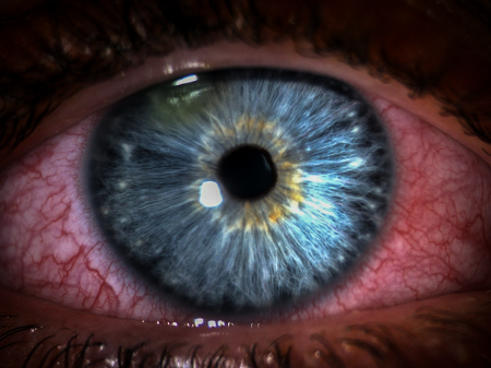 Nobody wants a painful eye!