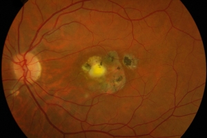 Smoking increases your risk of uveitis - beware!