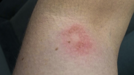 Paintball Injury